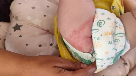 A mother is gently adjusting her baby's diaper to show the red rashes near the diaper area. 